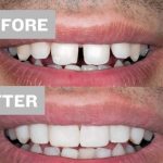 Read more about the article Same-Day Denture Repair in Gloucester, MA – Fast, Affordable, Reliable